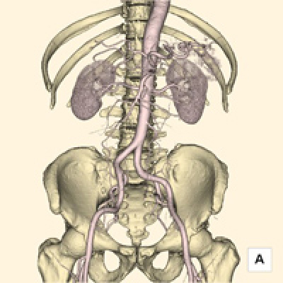 腹部血管3D画像