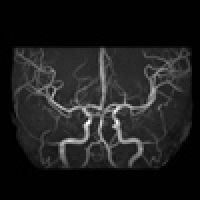 頭部血管画像（MRA）