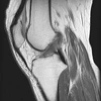 膝関節（プロトン強調画像）