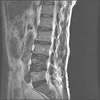 腰椎（T2強調画像）